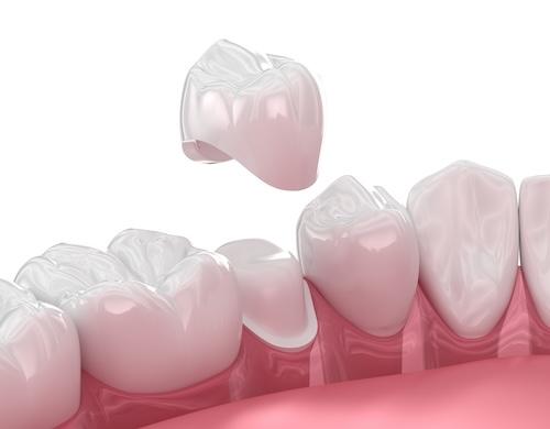 dental crown on lower tooth in jaw | dental crowns bellevue tn