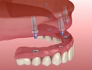 Implant supported dentures in Nashville TN